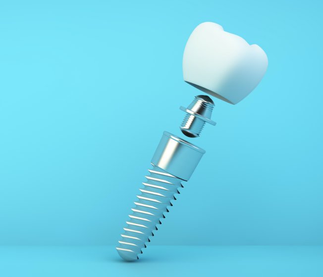 dental-implants