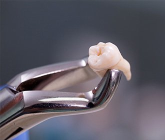 wisdom-tooth