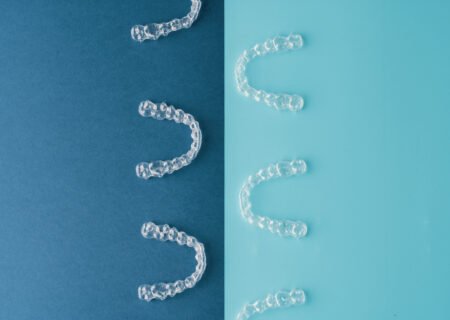 aligners