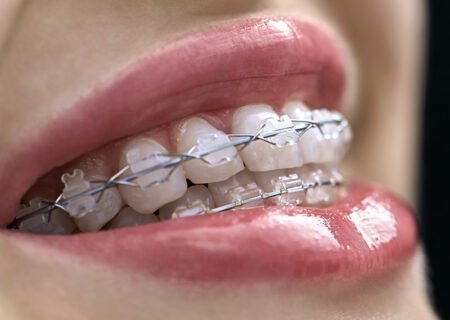 ceramic-braces
