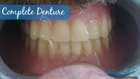 complete-denture