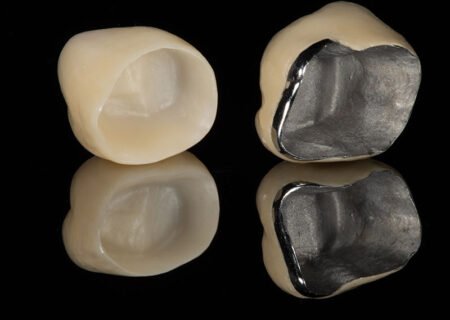 crowns-n-bridges