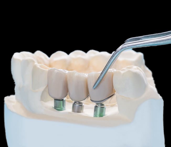 roots-dental-clinic-dental-implants-edit