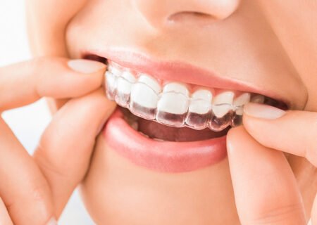 transparent-braces