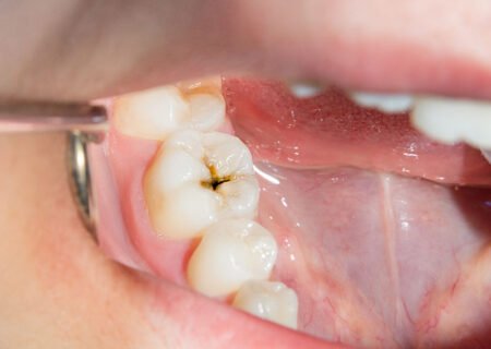 dental-filling