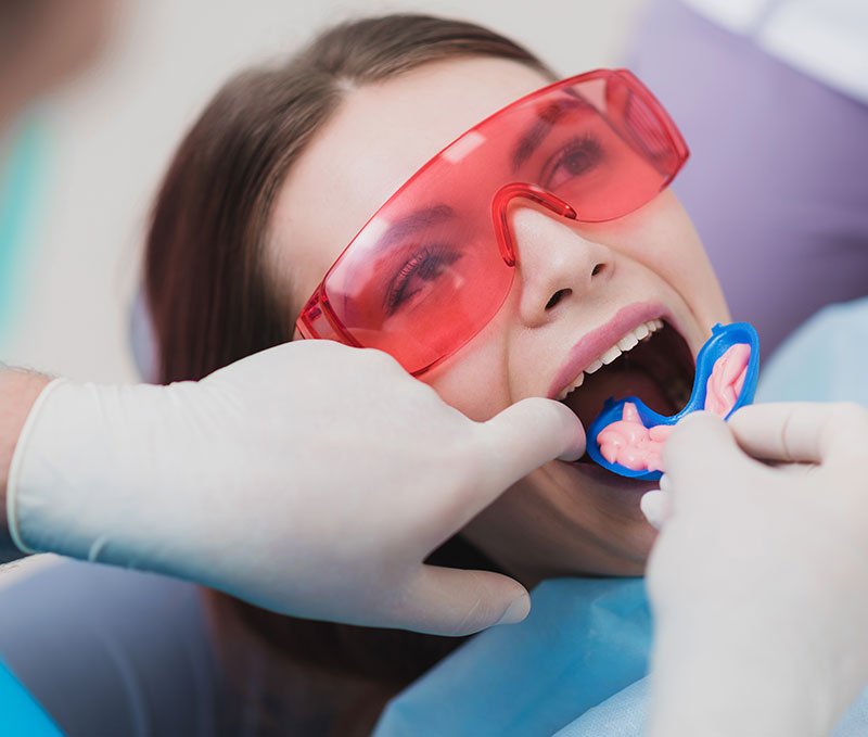 fluoride-treatment