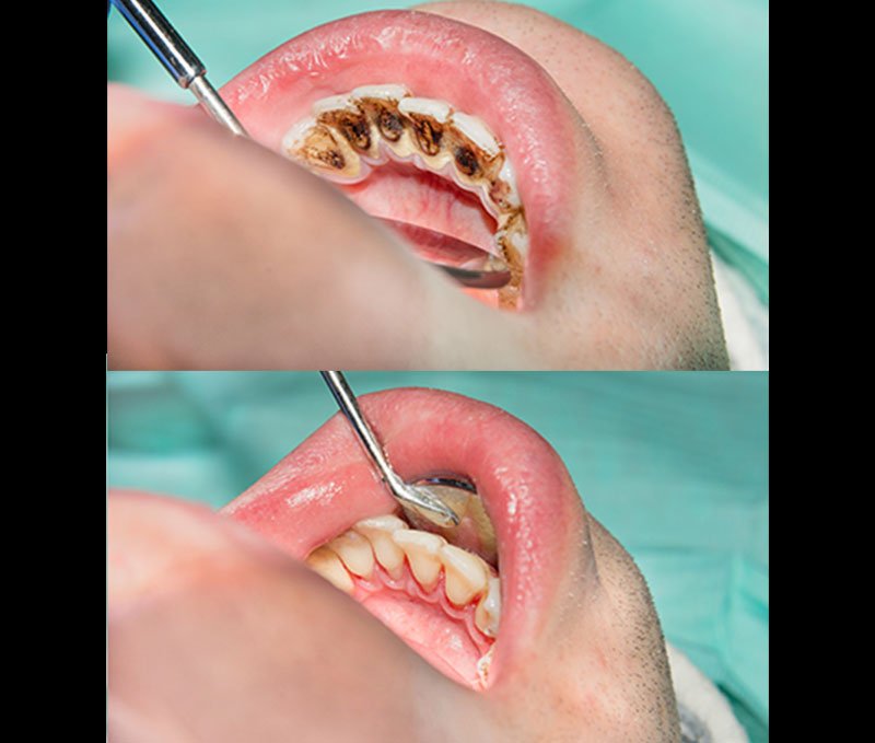 oral-propalyxsis