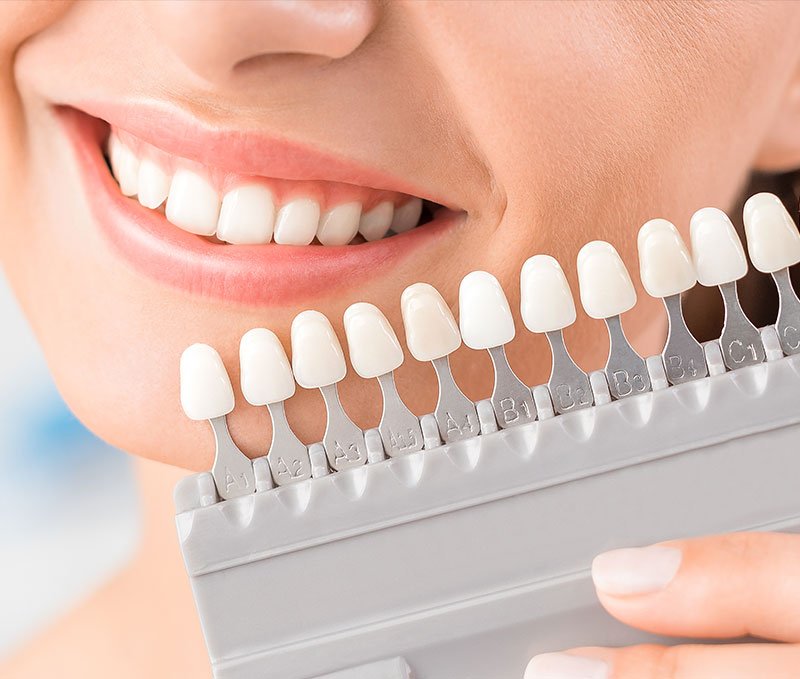 shade-card-smile-design