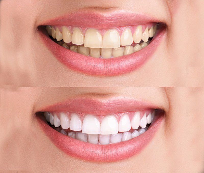 smile-design