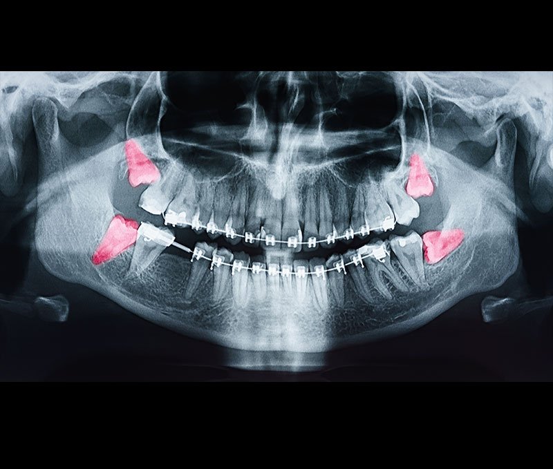 wisdom-tooth-removal